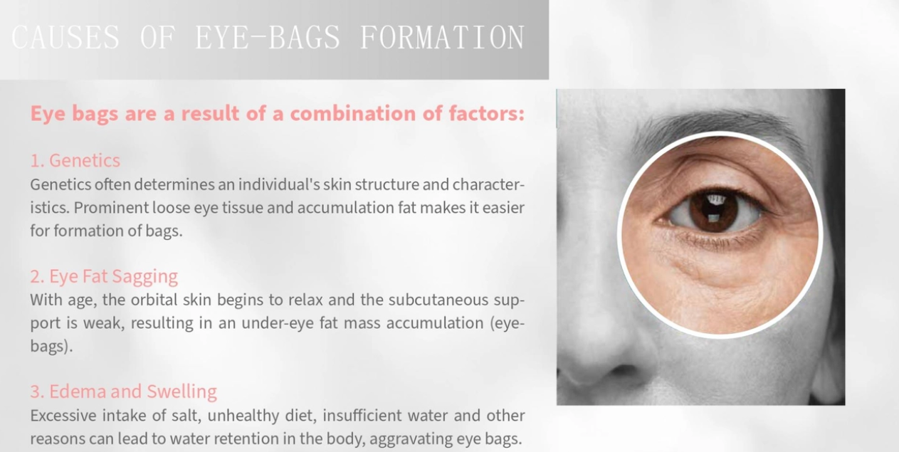 Fiola Eyebag Solution